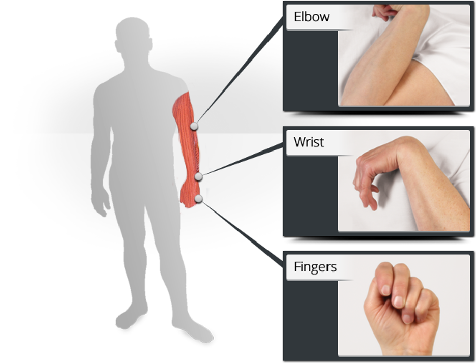 Spasticity StrokeOT spasticity-strokeot